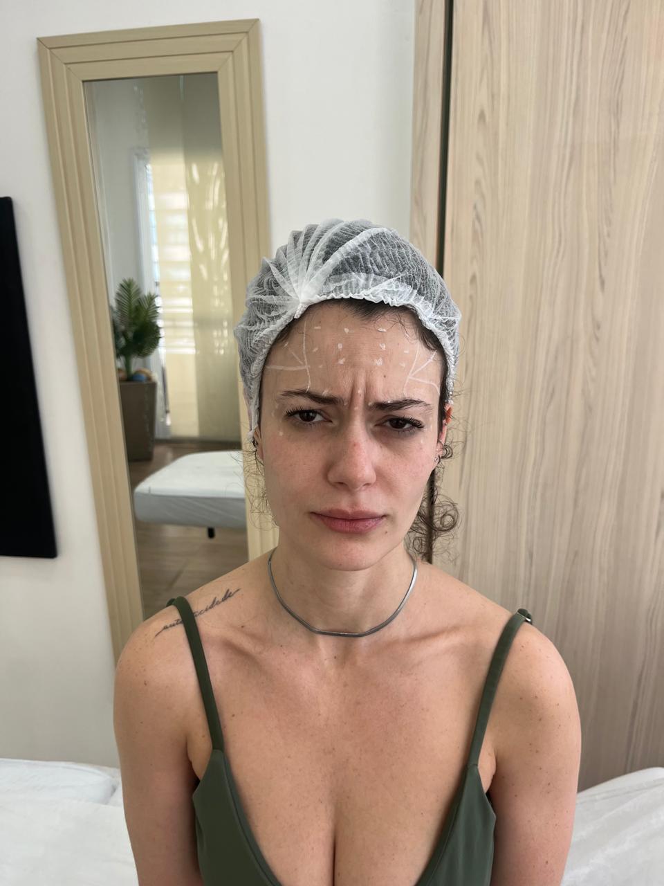 Linhas de expressão entre as sobrancelhas avaliadas antes do botox, na Clínica Sensitivity, em Osasco