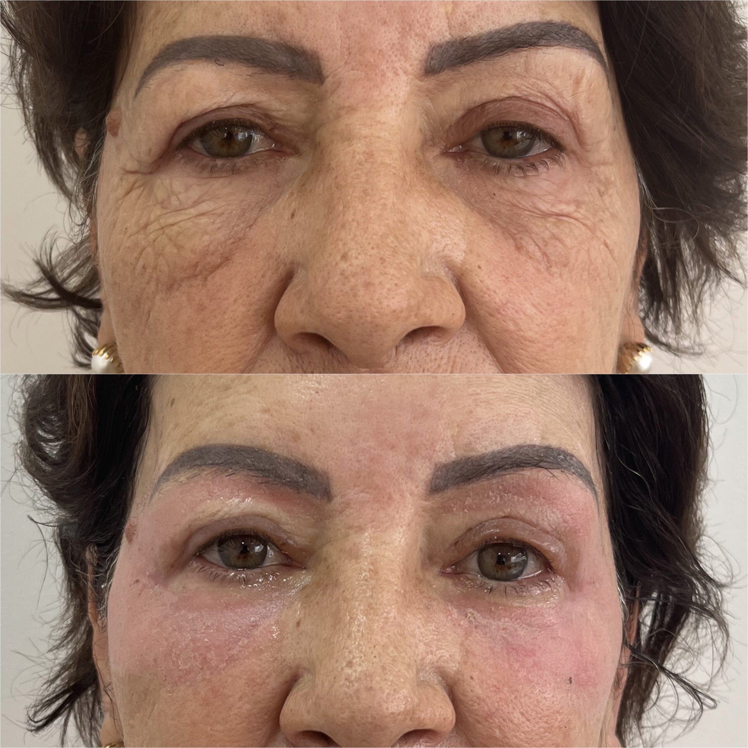 Antes e depois — Protocolo LineSkin — rejuvenescimento do olhar na Clínica Sensitivity, Osasco