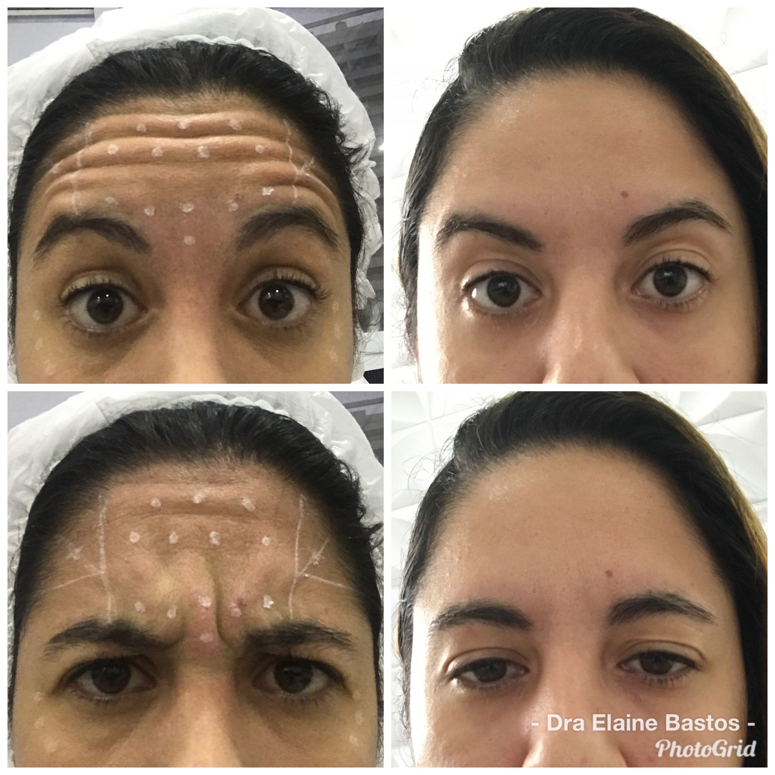 Toxina Botulínica Resultado 3