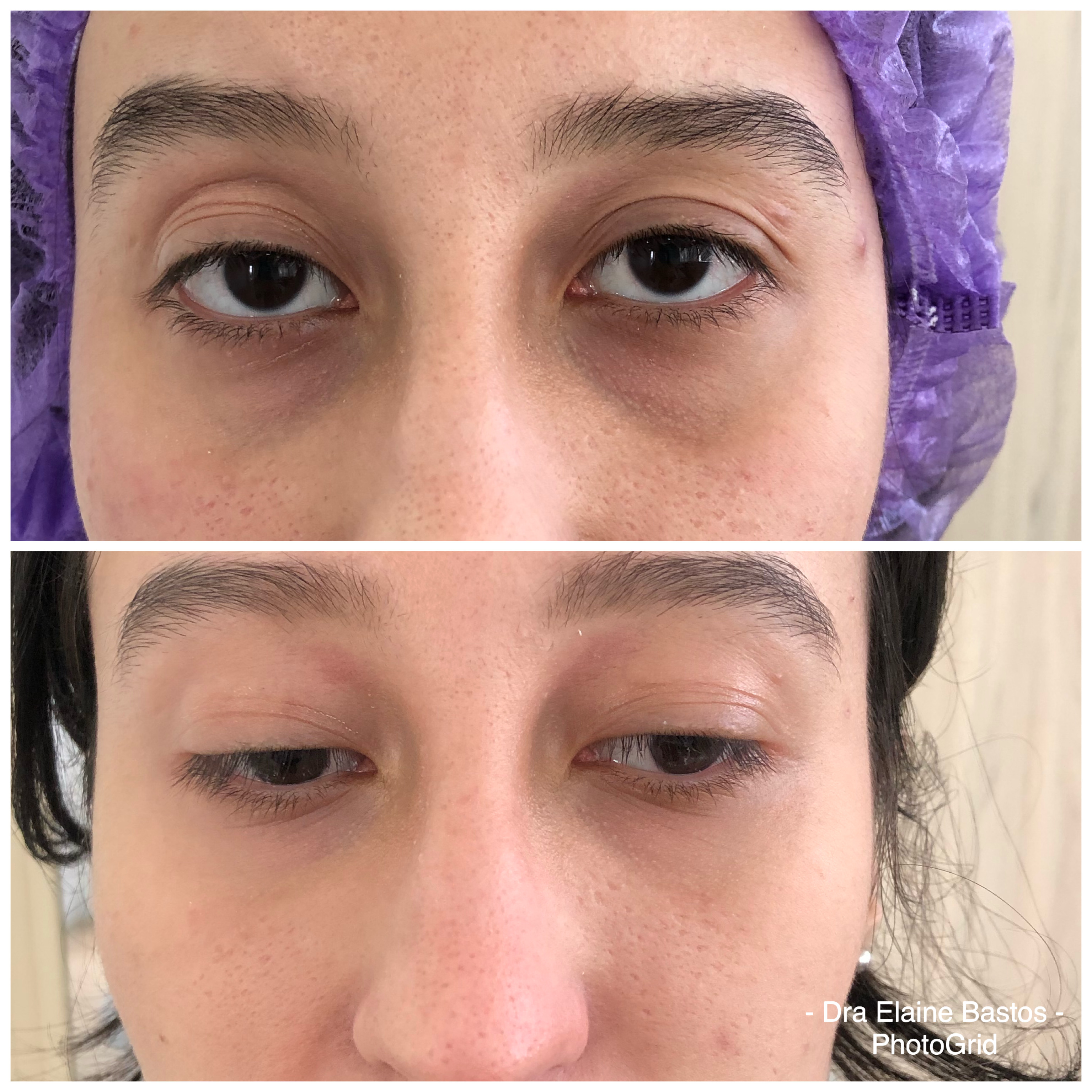 Olheiras Resultado 4