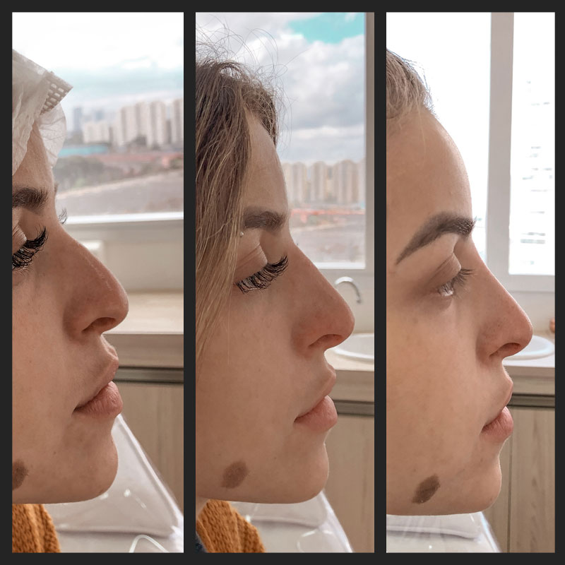 Rinomodelação Resultado 5