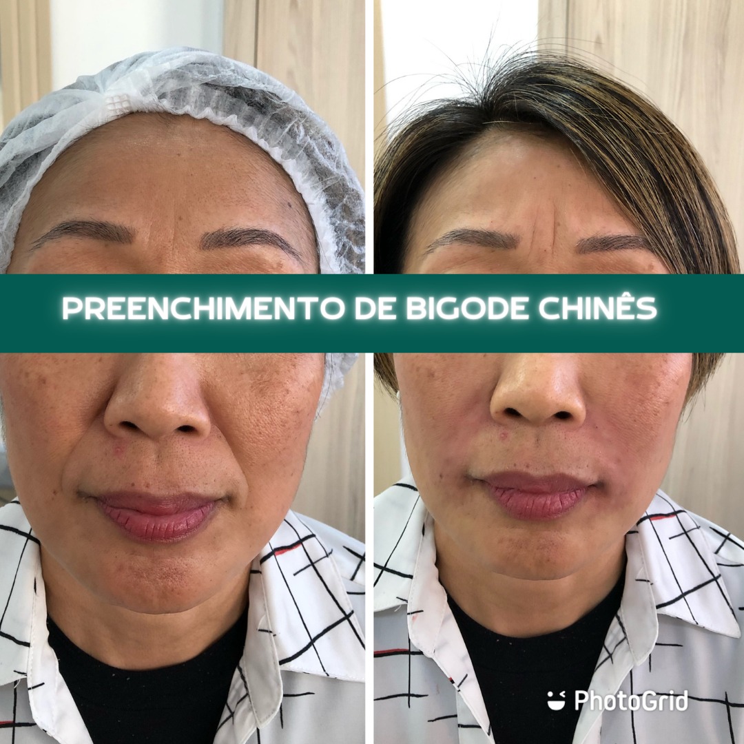 Transformação Bigode Chinês