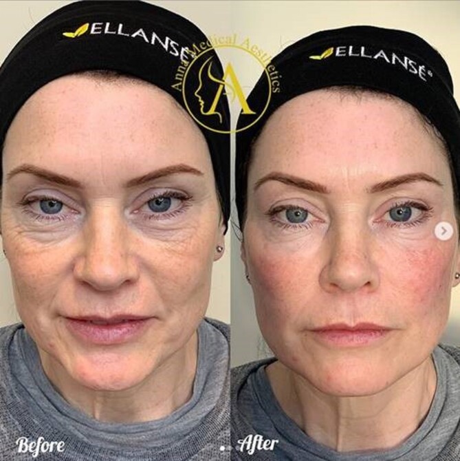 Mulher com pele radiante e firme após tratamento com bioestimuladores