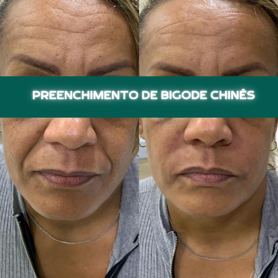 Bigode Chinês Resultado 3