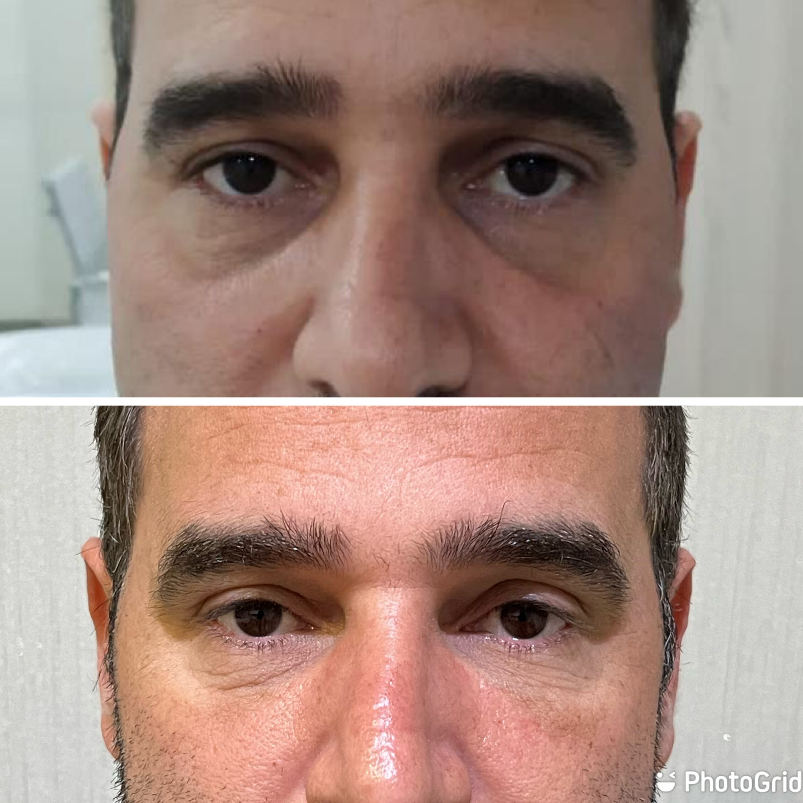 Olheiras Resultado 2