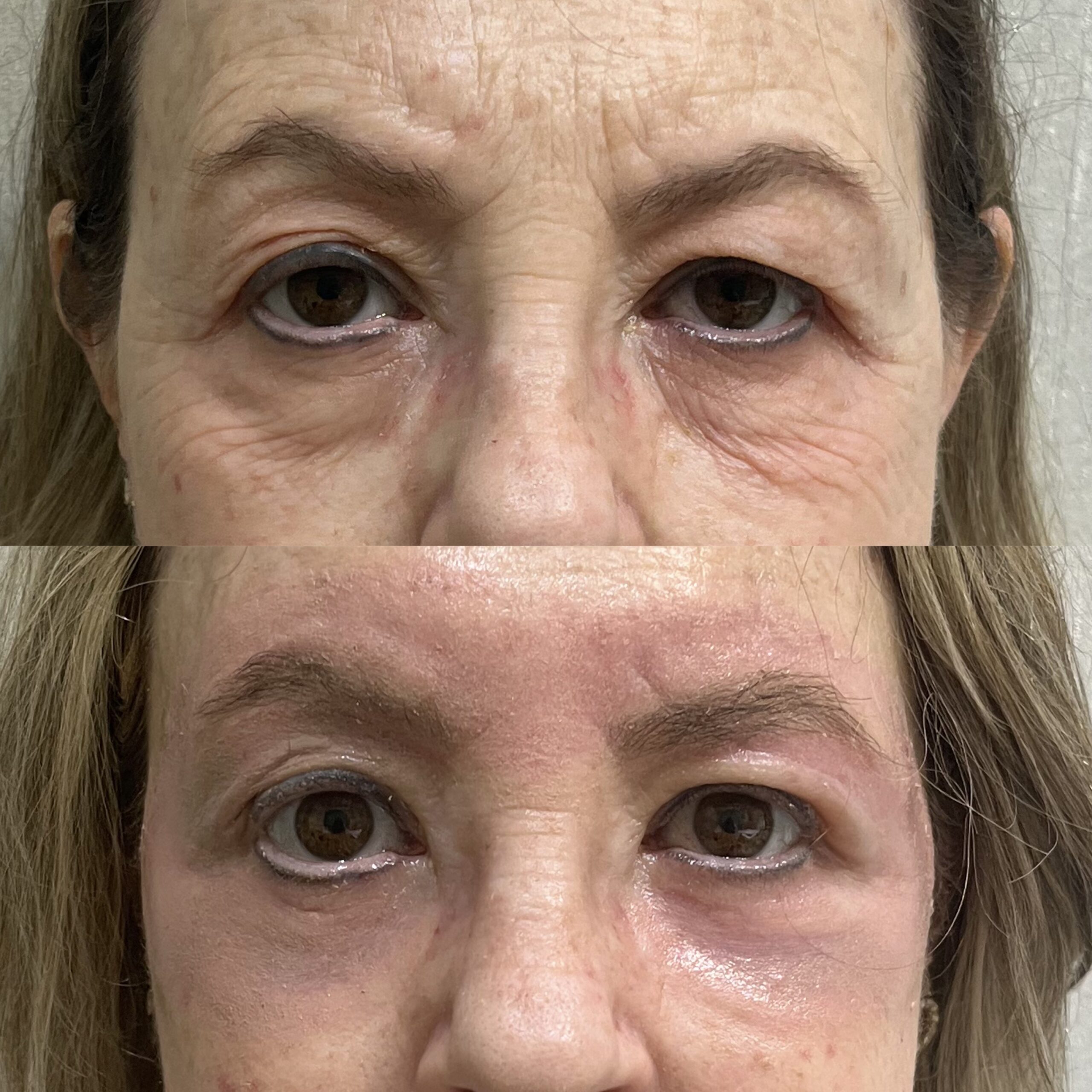 Rejuvenescimento de Pálpebras Resultado 2