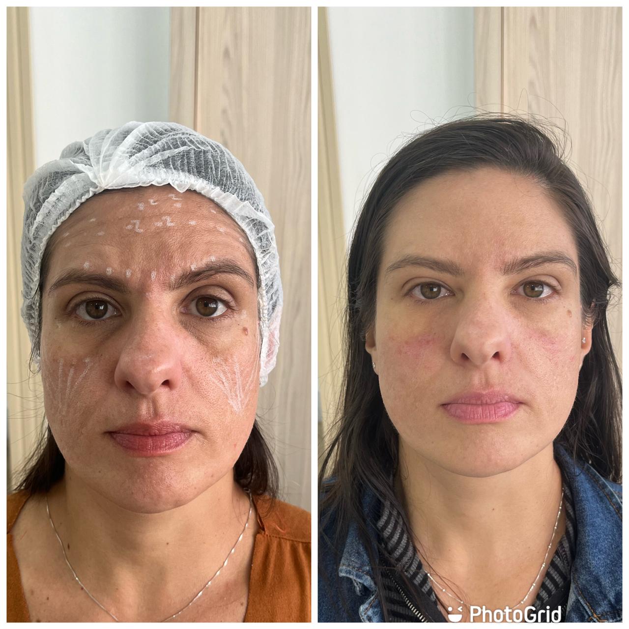 Antes e Depois 2