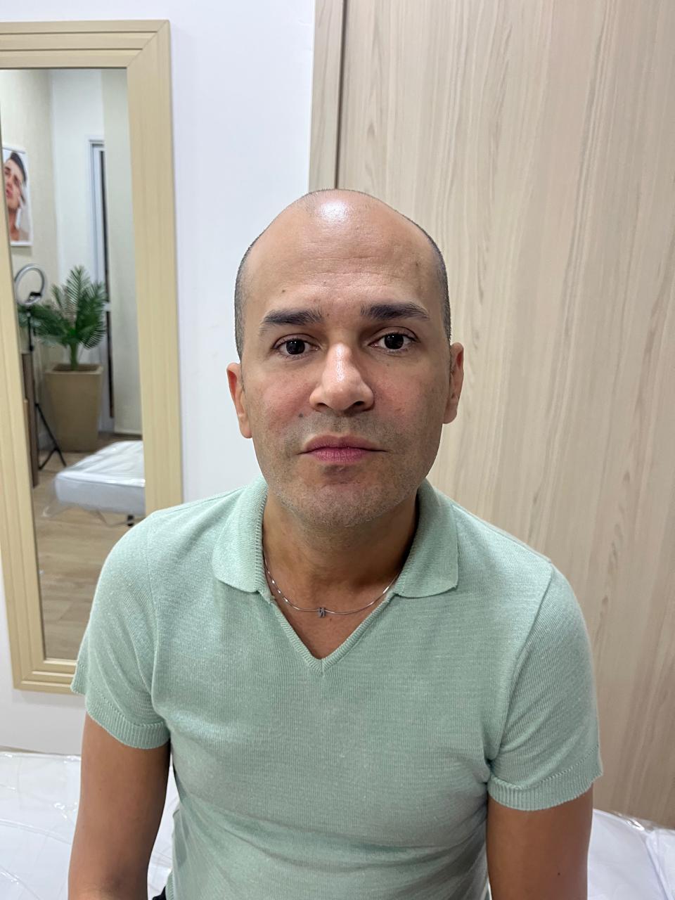 Antes Botox Olhos Osasco