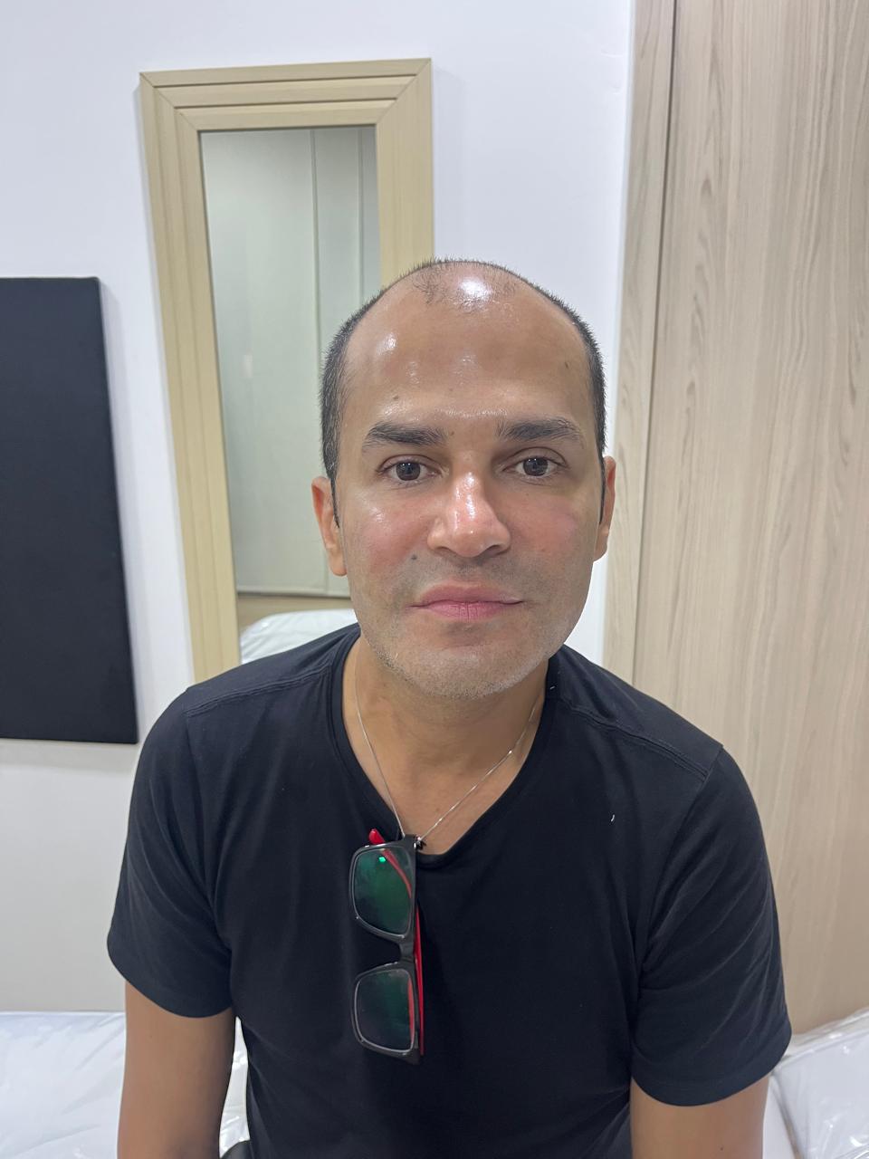 Depois Botox Olhos Osasco